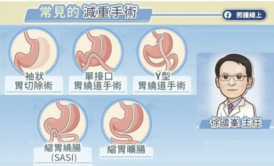 常見的減重手術